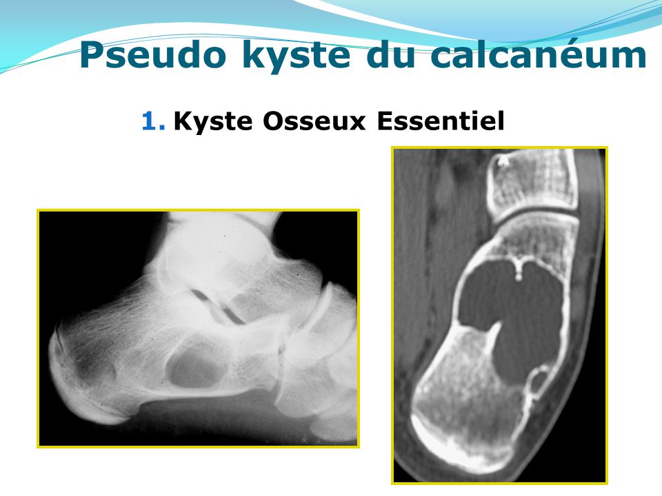 LES TUMEURS OSSEUSES PRIMITIVES DU CALCANEUM ppt video online